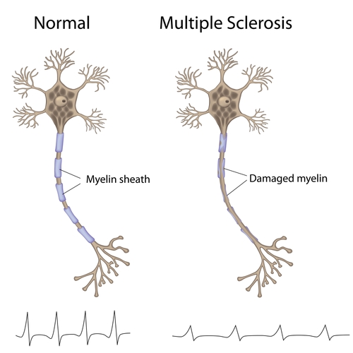 multiple-sclerose-nerv