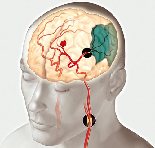 Mögliche Ursache eines Schlaganfalls: "verstopfte" Blutgefäße oder Blutungen